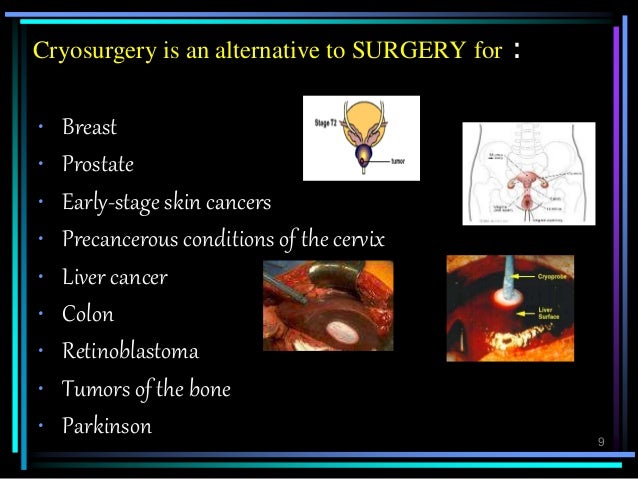 Cryosurgery & Cryotherapy Cryosurgery & Cryotherapy