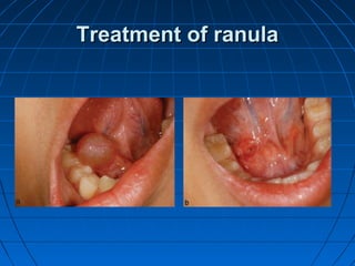 Pediatric Ranula Cryosurgery | PPT