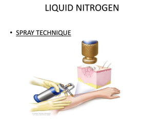 LIQUID NITROGEN
• SPRAY TECHNIQUE
 