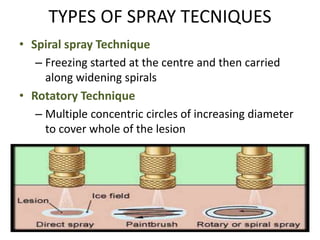 TYPES OF SPRAY TECNIQUES
• Spiral spray Technique
– Freezing started at the centre and then carried
along widening spirals
• Rotatory Technique
– Multiple concentric circles of increasing diameter
to cover whole of the lesion
 