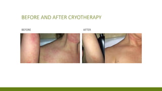 BEFORE AND AFTER CRYOTHERAPY
BEFORE AFTER
 
