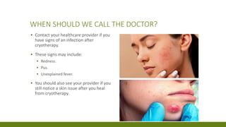 WHEN SHOULD WE CALL THE DOCTOR?
▪ Contact your healthcare provider if you
have signs of an infection after
cryotherapy.
▪ These signs may include:
▪ Redness.
▪ Pus.
▪ Unexplained fever.
▪ You should also see your provider if you
still notice a skin issue after you heal
from cryotherapy.
 
