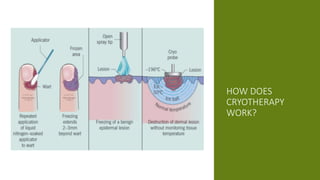 HOW DOES
CRYOTHERAPY
WORK?
 