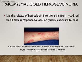 PAROXYSMAL COLD HEMOGLOBINURIA
• It is the release of hemoglobin into the urine from lysed red
blood cells in response to local or general exposure to cold
Rash on lower extremities typical of cutaneous small-vessel vasculitis due to
cryoglobulinemia secondary to hepatitis C infection
Contraindications…
 