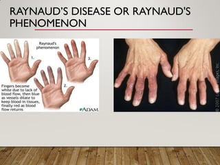 RAYNAUD’S DISEASE OR RAYNAUD'S
PHENOMENON
 