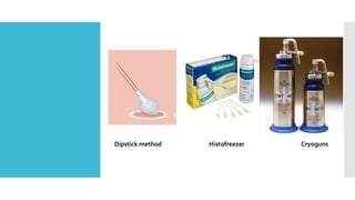 Dipstick method Histofreezer Cryoguns
 