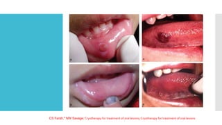 CS Farah,* NW Savage; Cryotherapy for treatment of oral lesions; Cryotherapy for treatment of oral lesions
 