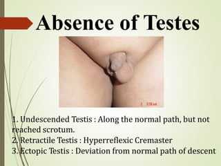 Absence of Testes
1. Undescended Testis : Along the normal path, but not
reached scrotum.
2. Retractile Testis : Hyperreflexic Cremaster
3. Ectopic Testis : Deviation from normal path of descent
 