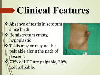  Absence of testis in scrotum
since birth
 Hemiscrotum empty,
hypoplastic
 Testis may or may not be
palpable along the path of
descent.
 70% of UDT are palpable, 30%
non palpable.
Clinical Features
 
