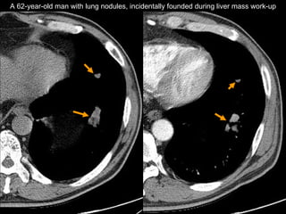 Chest CT A 62-year-old man with lung nodules, incidentally founded during liver mass work-up 