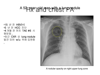 Hx and chest PA A 52-year-old man with a lung nodule ,[object Object],[object Object],[object Object],[object Object],A nodular opacity on right upper lung zone 