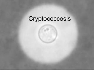 Cryptococcosis
 