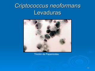 Criptococcus neoformans  Levaduras Tinción de Papanicolau 