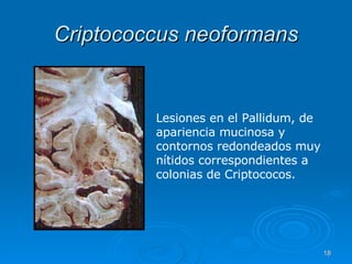 Criptococcus neoformans Lesiones en el Pallidum, de apariencia mucinosa y contornos redondeados muy nítidos correspondientes a colonias de Criptococos.   