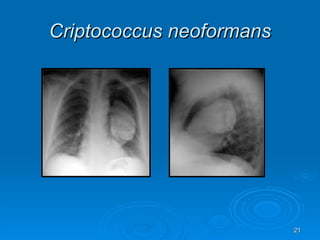Criptococcus neoformans 