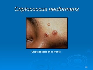 Criptococosis en la frente   Criptococcus neoformans 