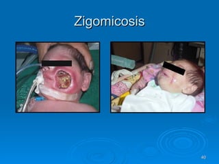 Zigomicosis 