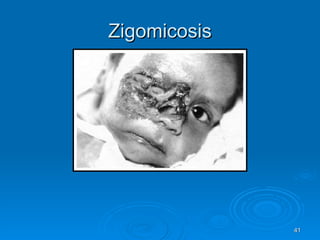 Zigomicosis 