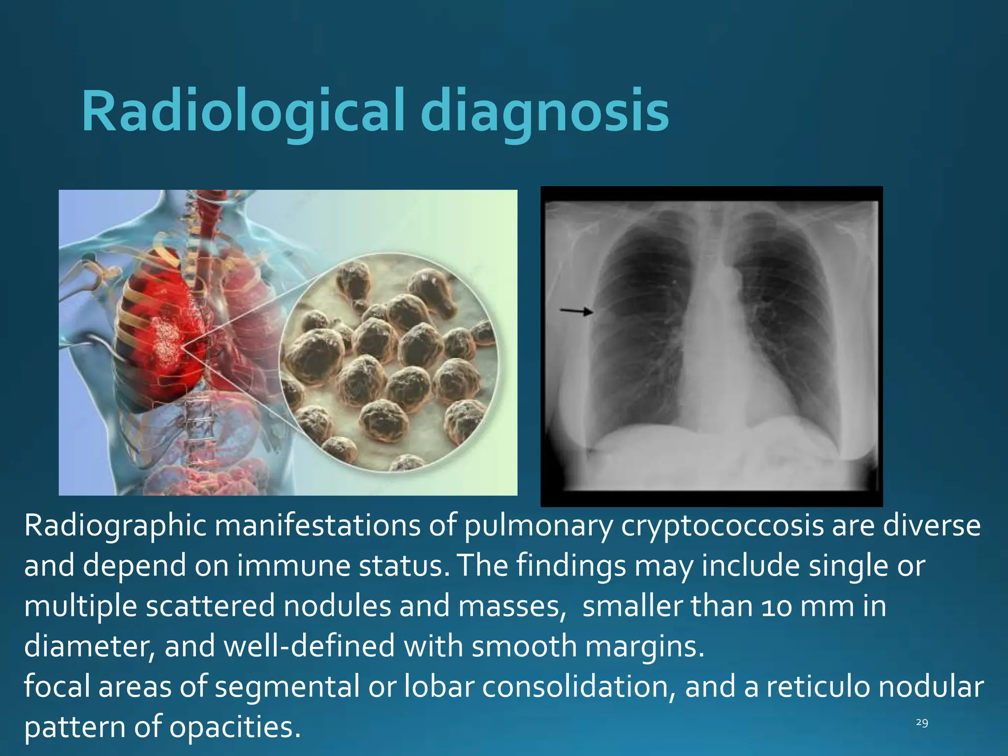Cryptococcus neoformans for bmit class.pptx | Medical Health