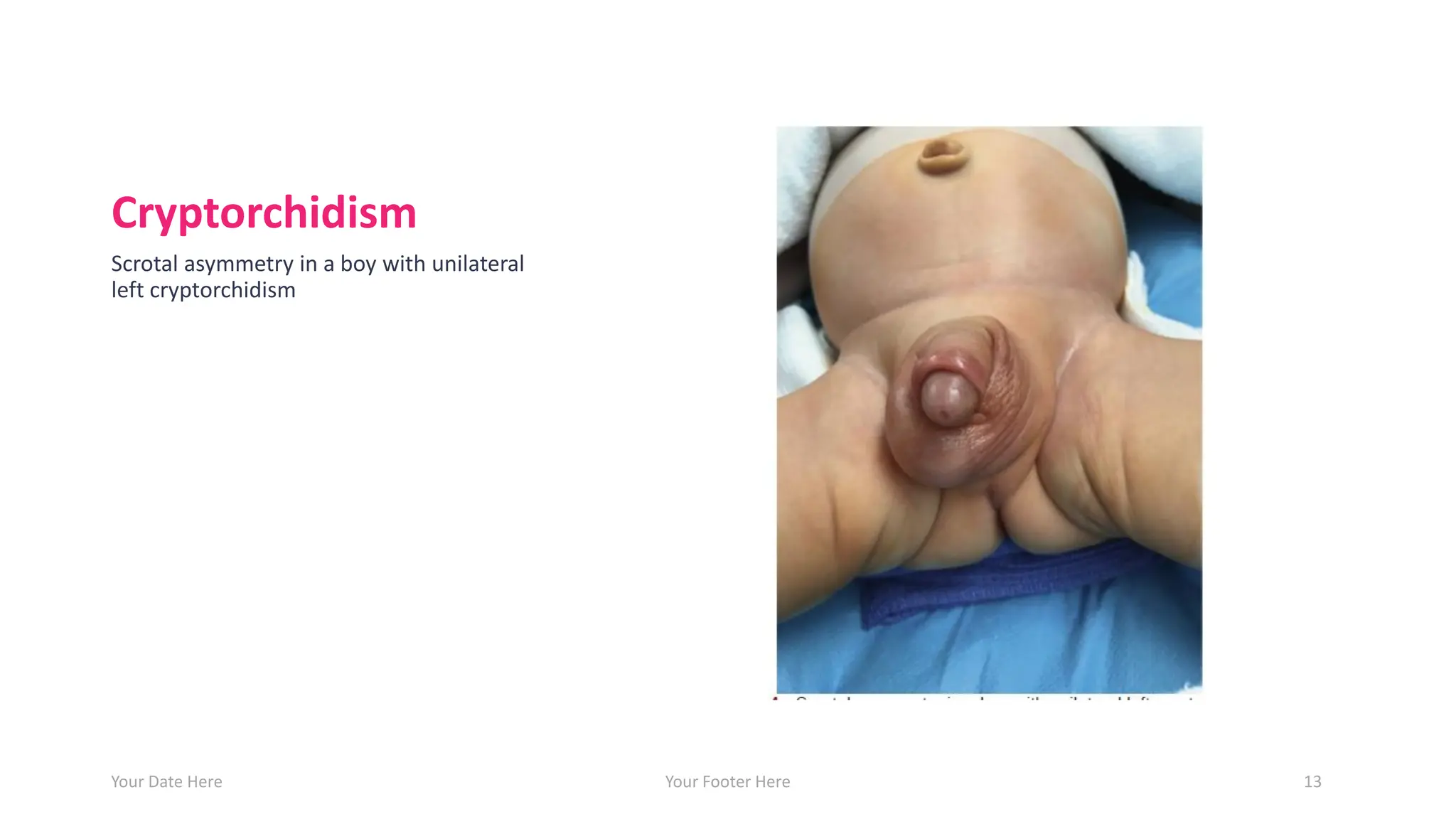 Cryptorchidism
Scrotal asymmetry in a boy with unilateral
left cryptorchidism
Your Date Here Your Footer Here 13
 