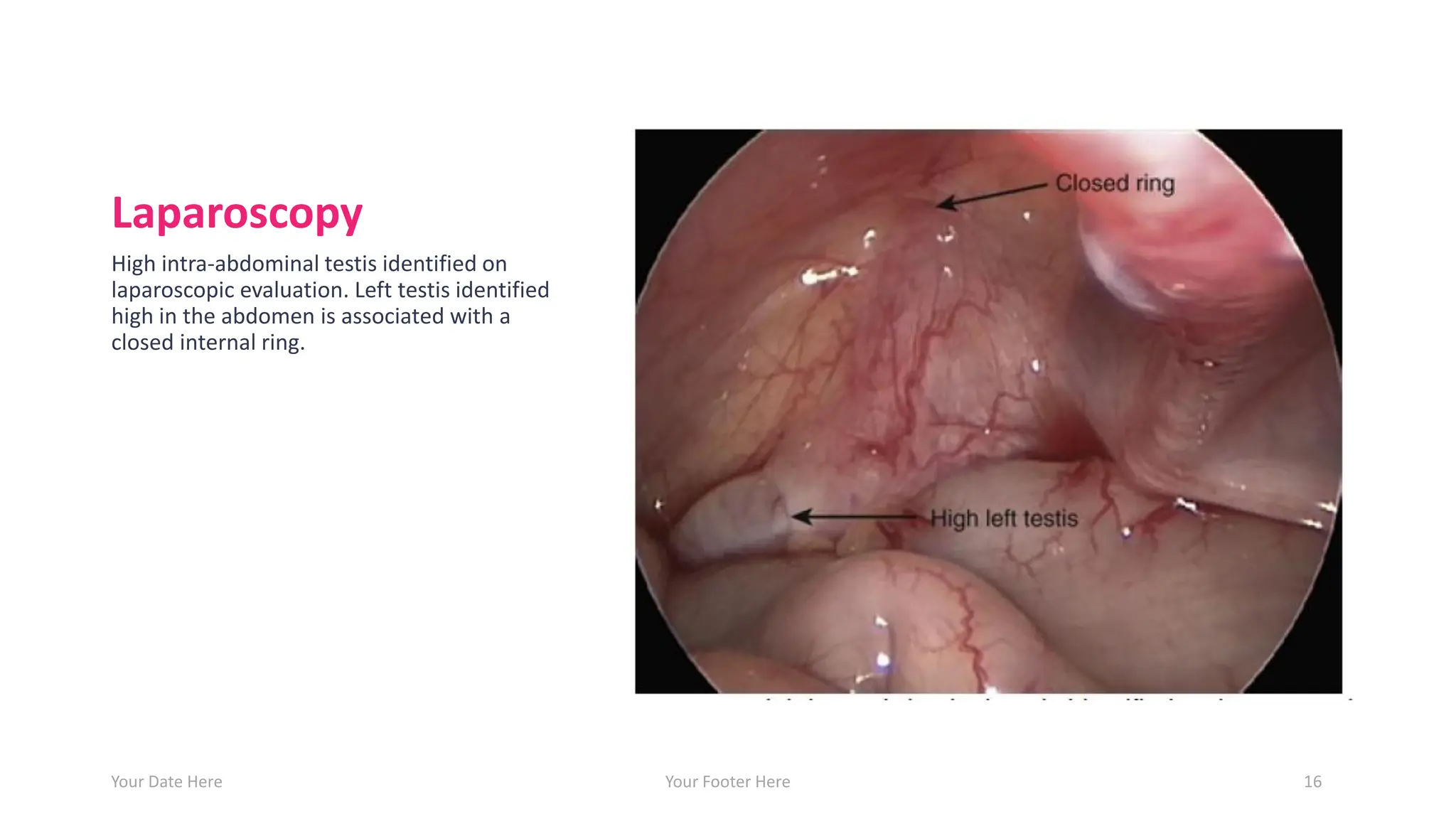 Laparoscopy
High intra-abdominal testis identified on
laparoscopic evaluation. Left testis identified
high in the abdomen is associated with a
closed internal ring.
Your Date Here Your Footer Here 16
 
