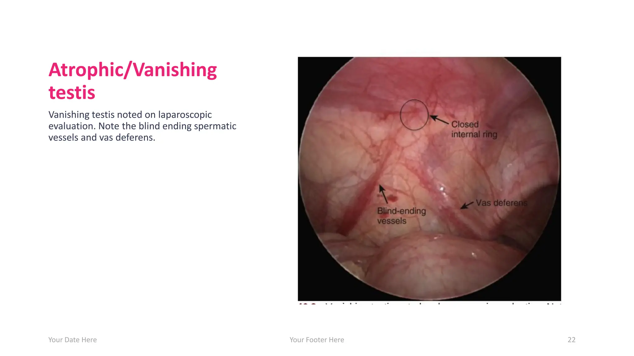 Atrophic/Vanishing
testis
Vanishing testis noted on laparoscopic
evaluation. Note the blind ending spermatic
vessels and vas deferens.
Your Date Here Your Footer Here 22
 
