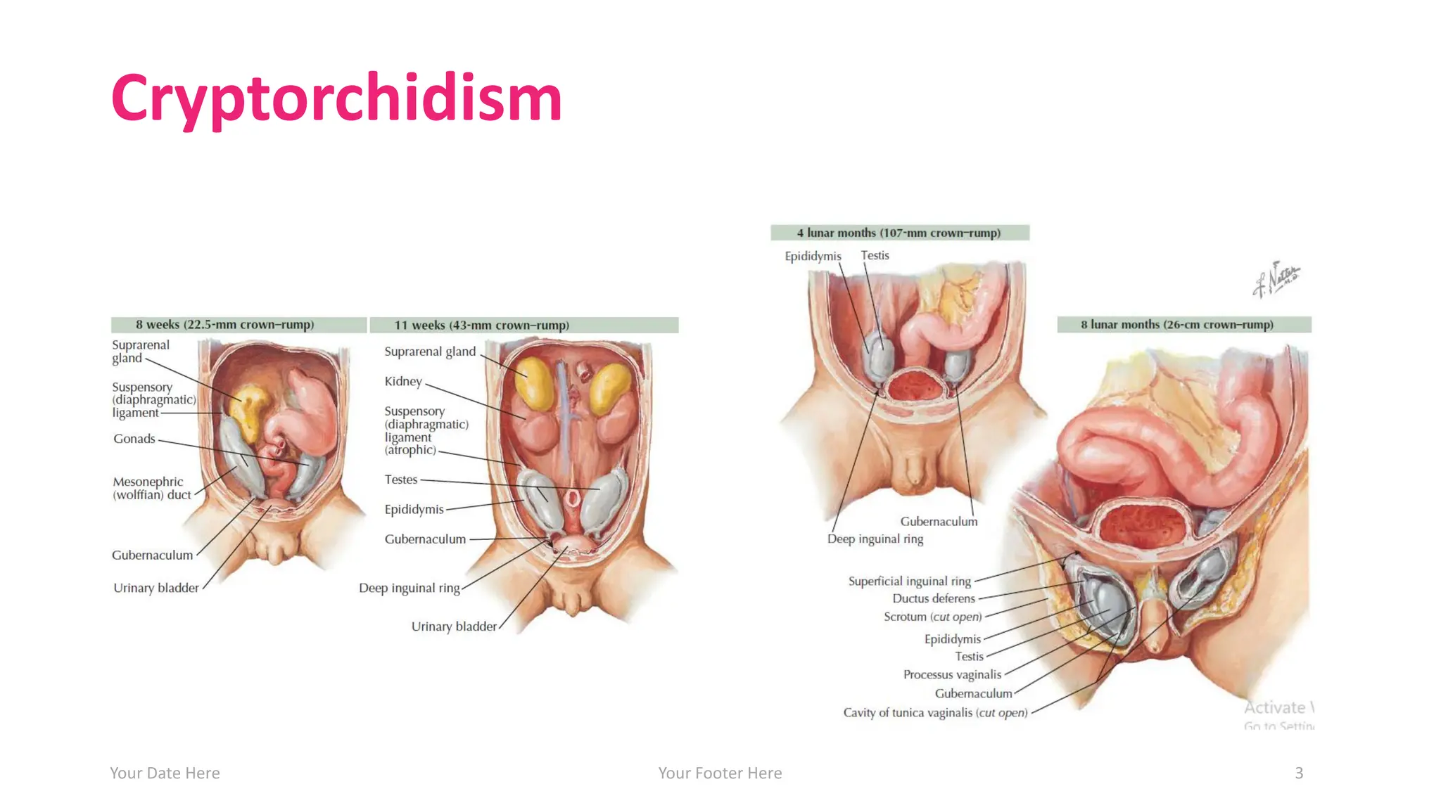 Cryptorchidism
Your Date Here Your Footer Here 3
 