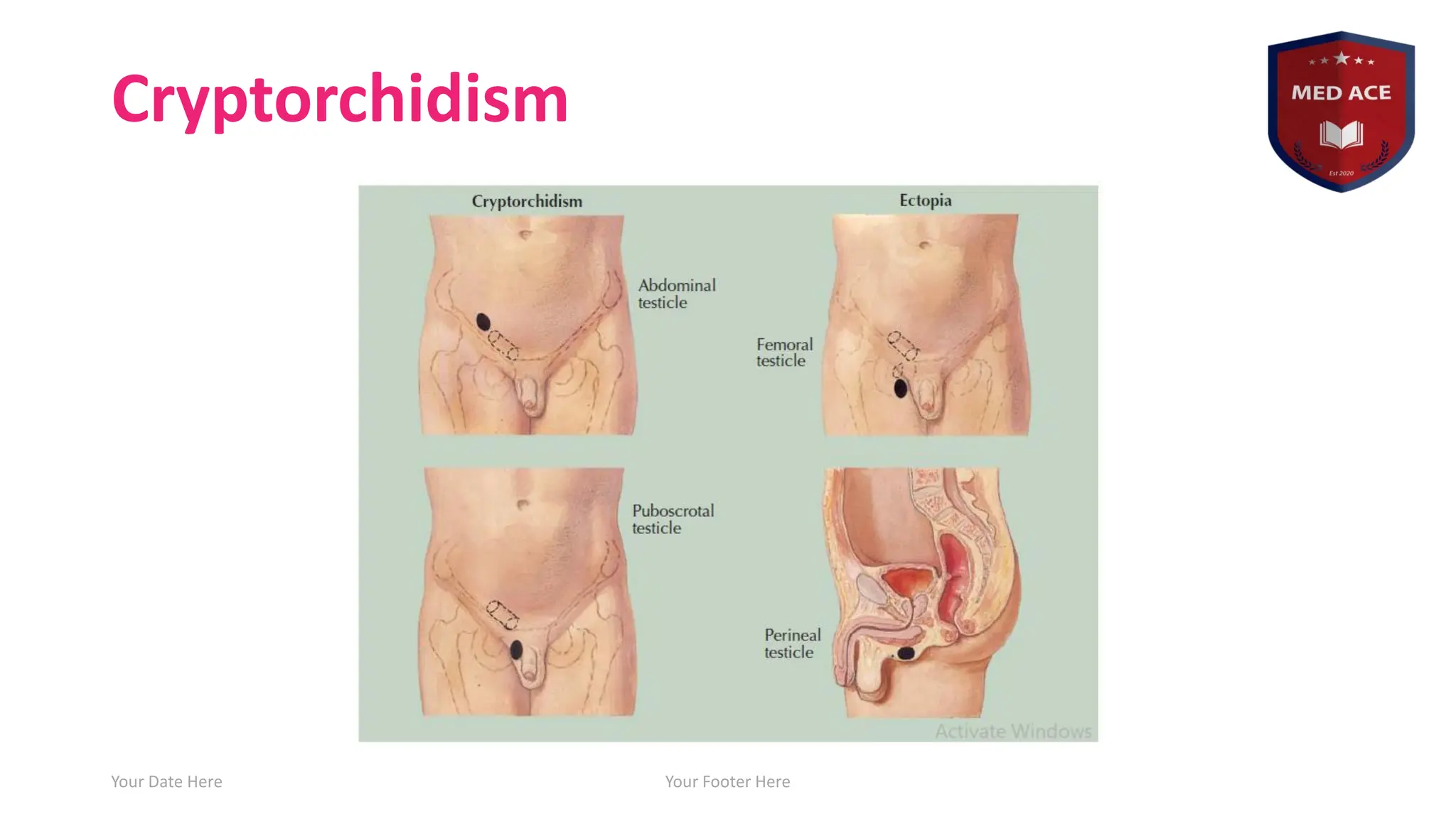 Cryptorchidism
Your Date Here Your Footer Here 7
 