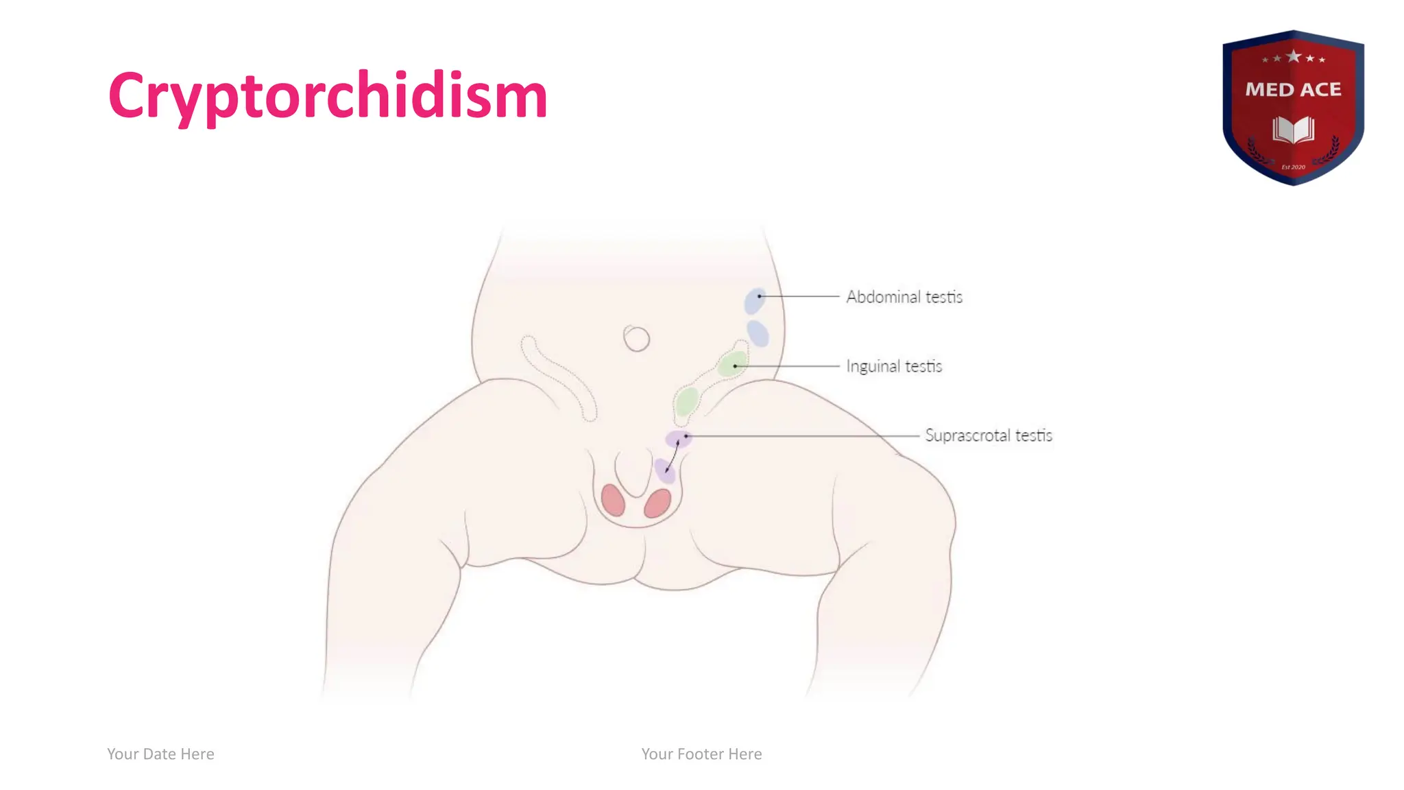 Cryptorchidism
Your Date Here Your Footer Here 8
 