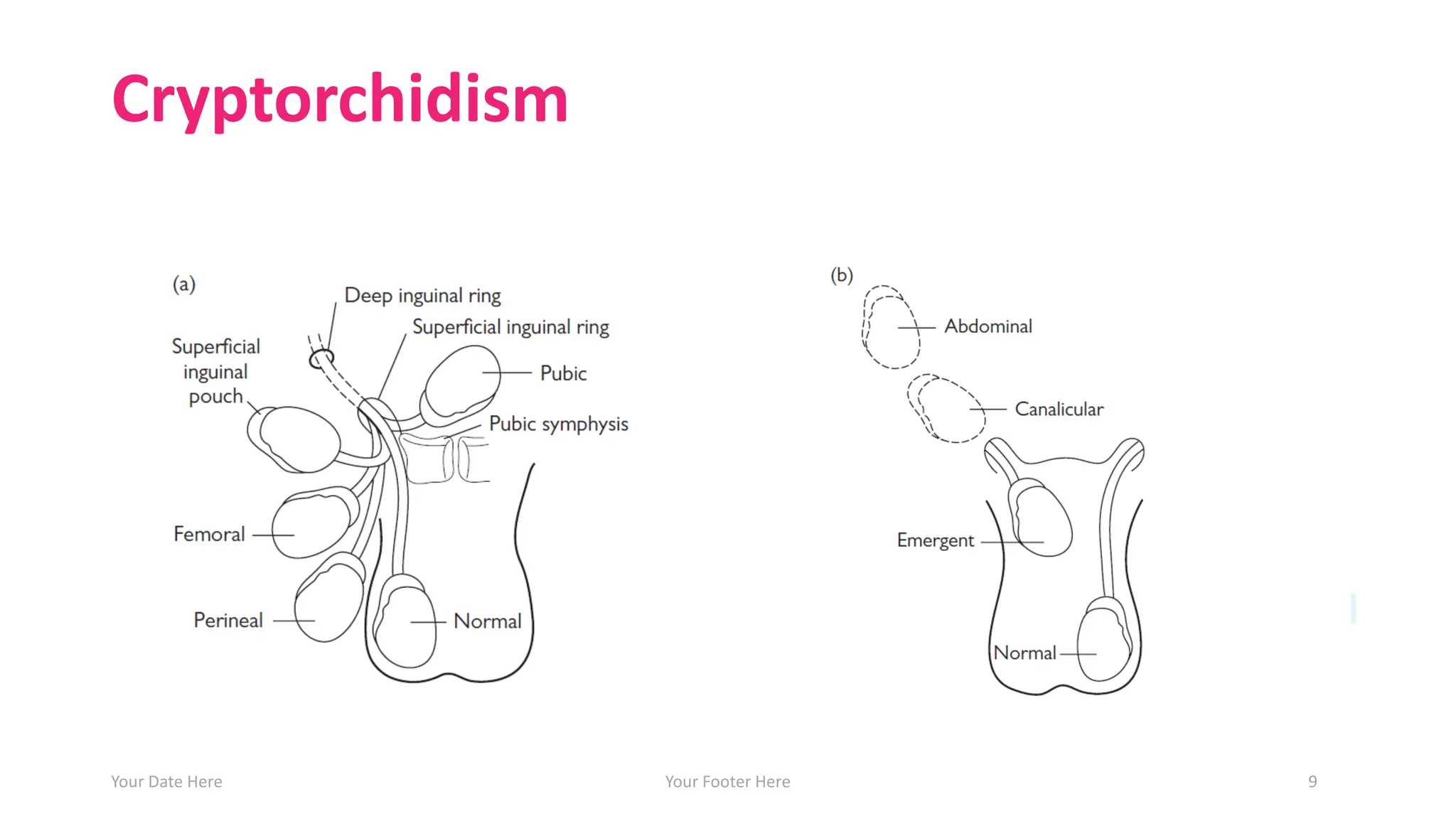 Cryptorchidism
Your Date Here Your Footer Here 9
 