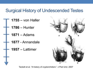 Surgical History of Undescended Testes
1755 – von Haller
1786 – Hunter
1871 – Adams
1877 - Annandale
1957 – Lattimer
Tackett et al. “A history of cryptorchidism.” J Ped Urol. 2007
 