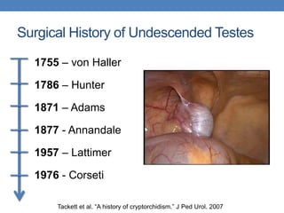 Surgical History of Undescended Testes
1755 – von Haller
1786 – Hunter
1871 – Adams
1877 - Annandale
1957 – Lattimer
1976 - Corseti
Tackett et al. “A history of cryptorchidism.” J Ped Urol. 2007
 