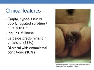 Clinical features
• Empty, hypoplastic or
poorly rugated scrotum /
hemiscrotum
• Inguinal fullness
• Left side predominant if
unilateral (58%)
• Bilateral with associated
conditions (10%)
Clark DA. Atlas of Neonatology - A companion to
Disease of the Newborn, 1st ed.
 