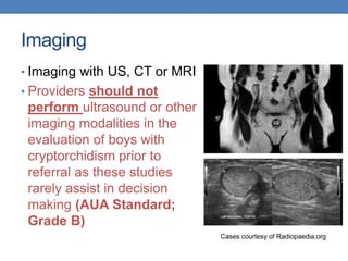 Imaging
• Imaging with US, CT or MRI
• Providers should not
perform ultrasound or other
imaging modalities in the
evaluation of boys with
cryptorchidism prior to
referral as these studies
rarely assist in decision
making (AUA Standard;
Grade B)
Cases courtesy of Radiopaedia.org
 