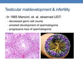 Testicular maldevelopment & infertility
• In 1965 Mancini, et. al. observed UDT:
• decreased germ cell counts
• arrested development of spermatogonia
• progressive loss of spermatogonia
 