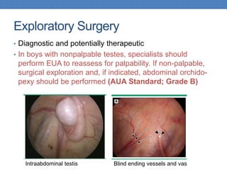 Exploratory Surgery
• Diagnostic and potentially therapeutic
• In boys with nonpalpable testes, specialists should
perform EUA to reassess for palpability. If non-palpable,
surgical exploration and, if indicated, abdominal orchido-
pexy should be performed (AUA Standard; Grade B)
Blind ending vessels and vasIntraabdominal testis
 