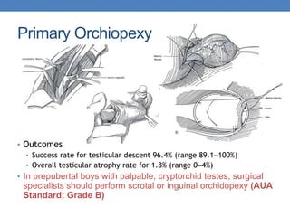 Primary Orchiopexy
• Outcomes
• Success rate for testicular descent 96.4% (range 89.1–100%)
• Overall testicular atrophy rate for 1.8% (range 0–4%)
• In prepubertal boys with palpable, cryptorchid testes, surgical
specialists should perform scrotal or inguinal orchidopexy (AUA
Standard; Grade B)
 