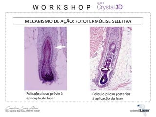 MECANISMO DE AÇÃO: FOTOTERMÓLISE SELETIVA
Folículo piloso prévio à
aplicação do laser
Folículo piloso posterior
à aplicação do laser
 