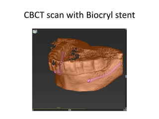 Biocryl Inj Crystal guide codiagnostix workflow | PPTX