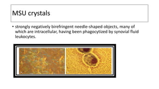 MSU crystals
• strongly negatively birefringent needle-shaped objects, many of
which are intracellular, having been phagocytized by synovial fluid
leukocytes.
 