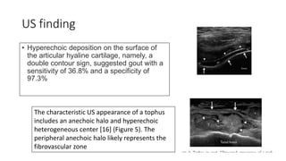 US finding
• Hyperechoic deposition on the surface of
the articular hyaline cartilage, namely, a
double contour sign, suggested gout with a
sensitivity of 36.8% and a specificity of
97.3%
The characteristic US appearance of a tophus
includes an anechoic halo and hyperechoic
heterogeneous center [16] (Figure 5). The
peripheral anechoic halo likely represents the
fibrovascular zone
 