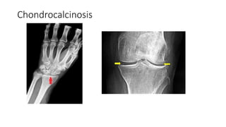 Chondrocalcinosis
 