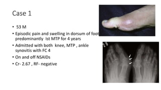 Case 1
• 53 M
• Episodic pain and swelling in dorsum of foot ,
predominantly Ist MTP for 4 years
• Admitted with both knee, MTP , ankle
synovitis with FC 4
• On and off NSAIDs
• Cr- 2.67 , RF- negative
 