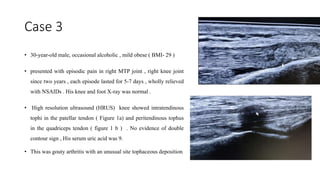Case 3
• 30-year-old male, occasional alcoholic , mild obese ( BMI- 29 )
• presented with episodic pain in right MTP joint , right knee joint
since two years , each episode lasted for 5-7 days , wholly relieved
with NSAIDs . His knee and foot X-ray was normal .
• High resolution ultrasound (HRUS) knee showed intratendinous
tophi in the patellar tendon ( Figure 1a) and peritendinous tophus
in the quadriceps tendon ( figure 1 b ) . No evidence of double
contour sign , His serum uric acid was 9.
• This was gouty arthritis with an unusual site tophaceous deposition
 