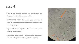 case 4
• This 60 year old male presented with multiple small and
large joint arthritis with olecranon bursitis .
• X-RAY BOTH FOOT showed joint space narrowing of
right 1st IP joint with osteophytes with subchondral cyst and
overhanging edges .
• Synovial fluid from right knee showed uric acid crystals
however uric acid was 6.3.
• Intracellular needle crystals ( crystals crossing neutrophils )
are more pathognomonic of Gouty arthritis ( Figure2 )
 