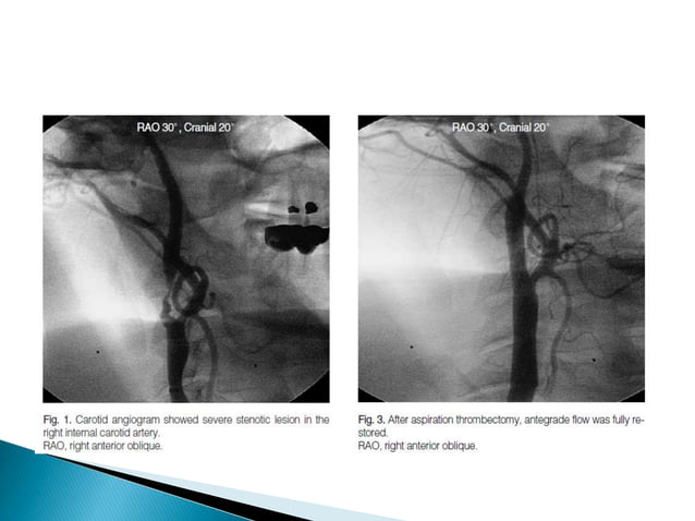 CAROTID ARTERY STENOSIS | PPTX | Heart and Cardiovascular Diseases ...