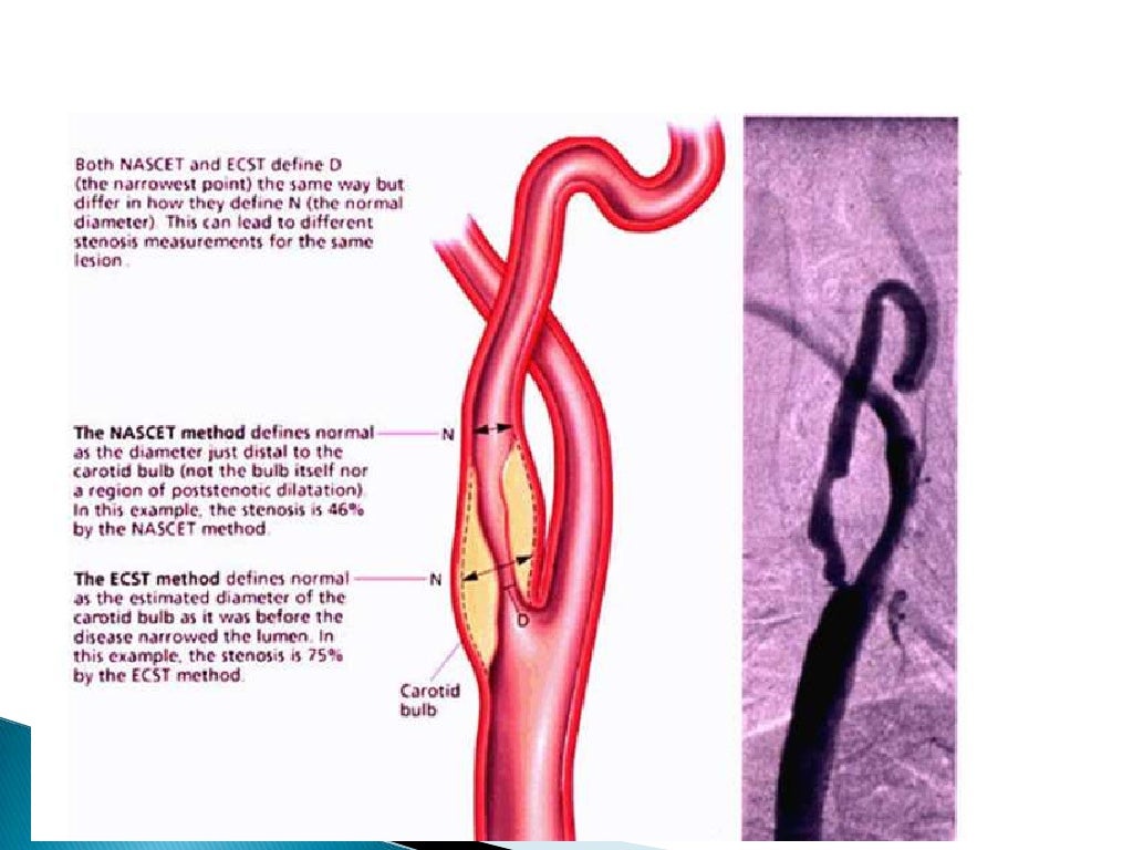 CAROTID ARTERY STENOSIS