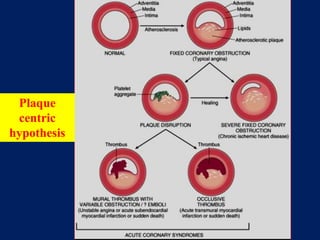 Plaque
centric
hypothesis
 
