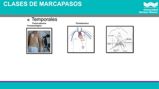 CLASES DE MARCAPASOS
■ Temporales
Transcutáneos Transtóraxico
Transesofagico