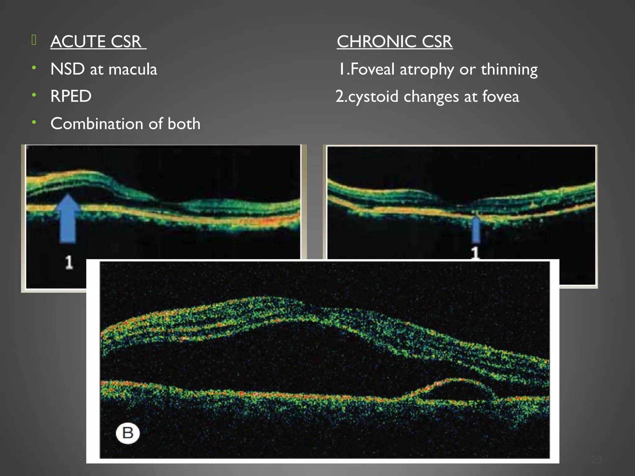  ACUTE CSR CHRONIC CSR
• NSD at macula 1.Foveal atrophy or thinning
• RPED 2.cystoid changes at fovea
• Combination of both
23
 